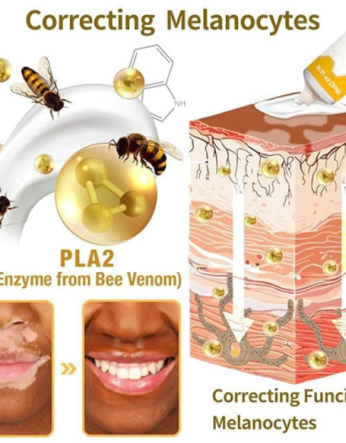 The Gir Farmer bee venom vitiligo cream showing skin correction with PLA2 enzyme and improving melanocytes function