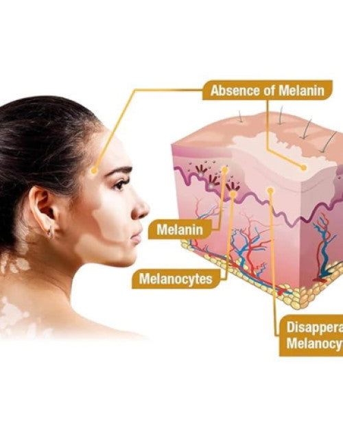 Diagram showing skin layers and melanin related to vitiligo for bee venom vitiligo cream by The Gir Farmer