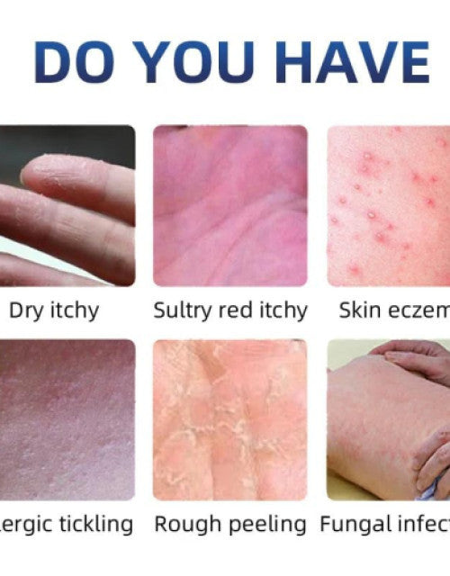 Eczema and fungal cream pack showing images of dry itchy, red itchy, skin eczema, allergic tickling, rough peeling, and fungal infection conditions
