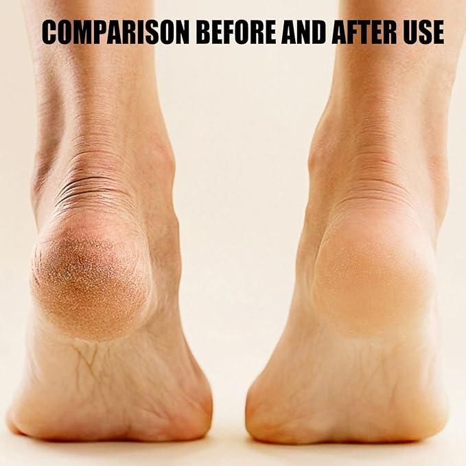 Comparison of heels before and after using electronic pedicure tool showing smoother skin on the right