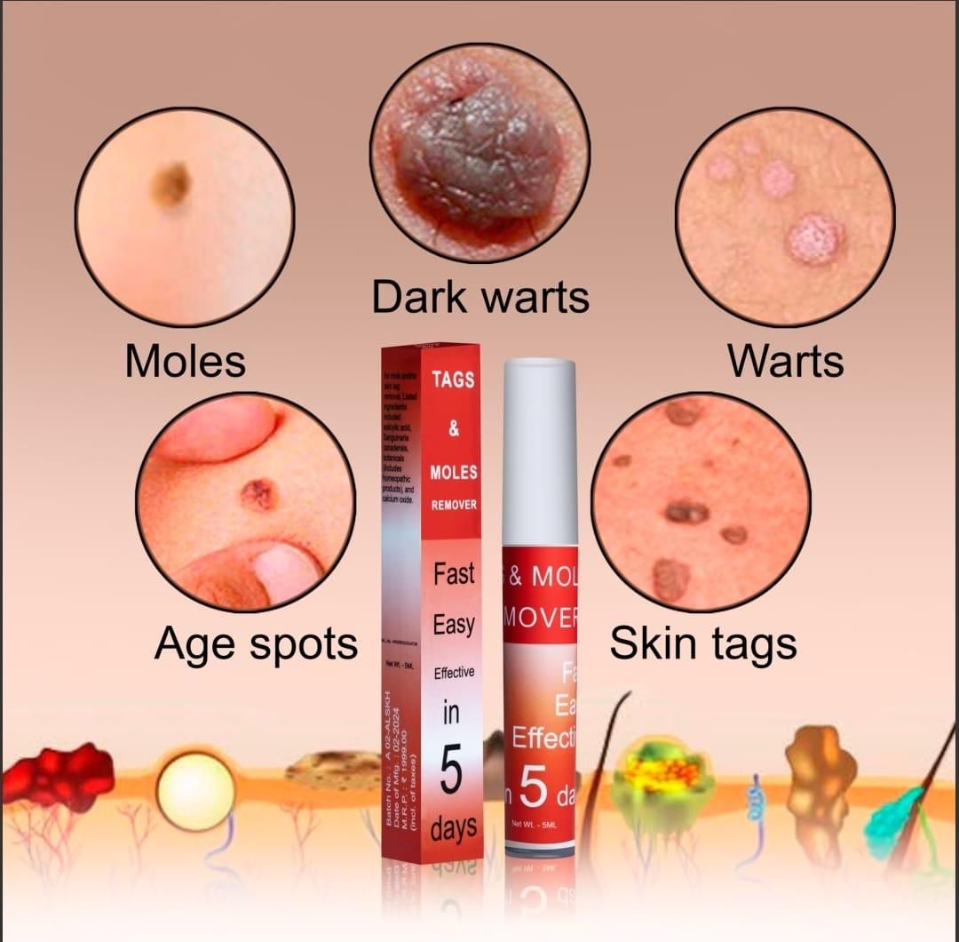 Fast acting tag and mole remover with images of moles dark warts warts age spots and skin tags