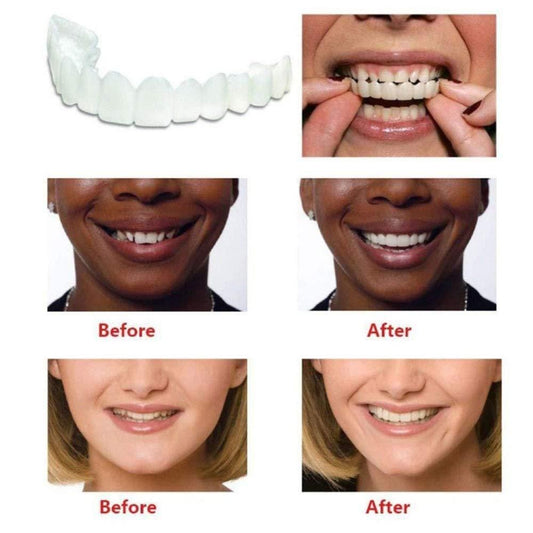 Flex cosmetic teeth veneers shown with before and after smiles for enhanced dental appearance