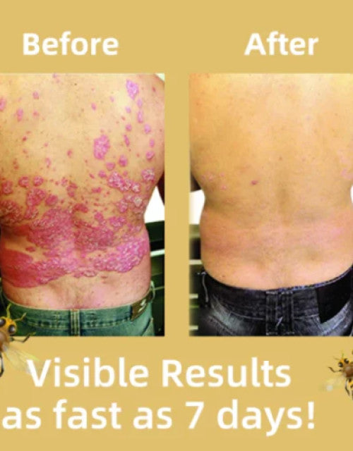 Before and after results of using bee venom psoriasis cream for skin treatment