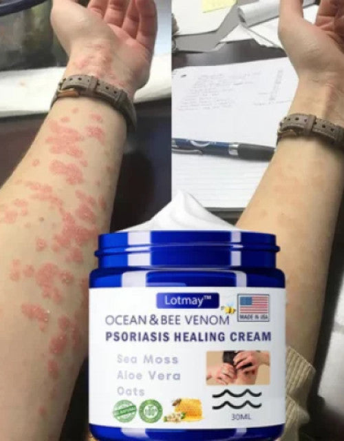 Dropdash Ocean & Bee Venom Psoriasis Cream with soothing ingredients for skin healing