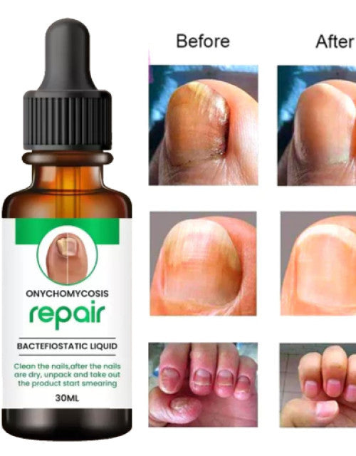 The Gir Farmer best nail repair treatment pack showing before and after results of nail fungus repair liquid