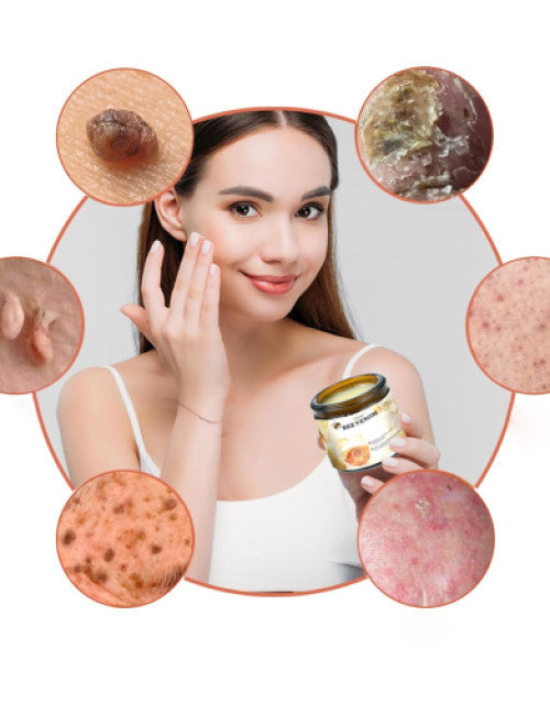 Woman applying bee venom cream for acne scars from The Gir Farmer with close-ups of acne scar treatments
