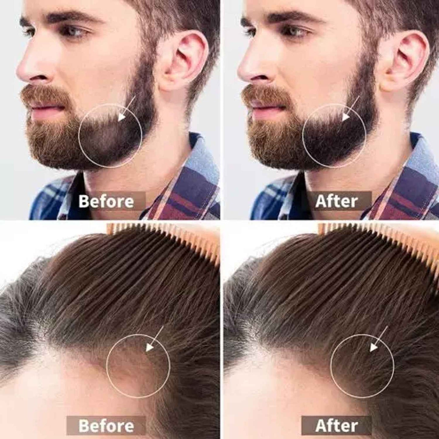 Derma Roller For Hair Growth