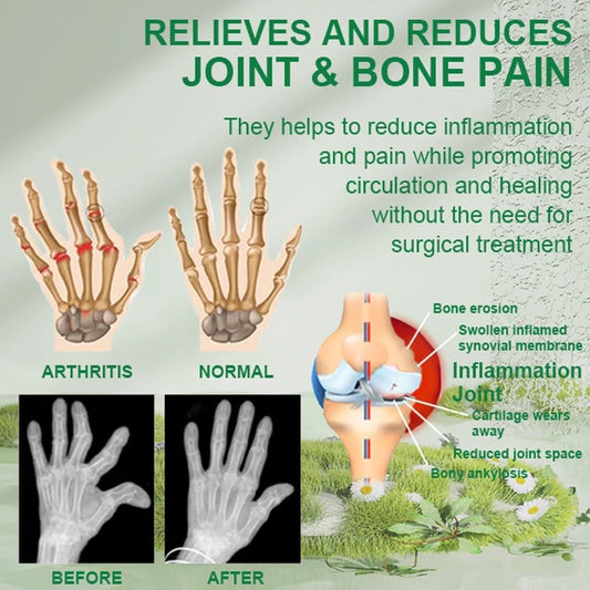 Bee venom joint cream infographic showing benefits for arthritis relief and reduced joint pain