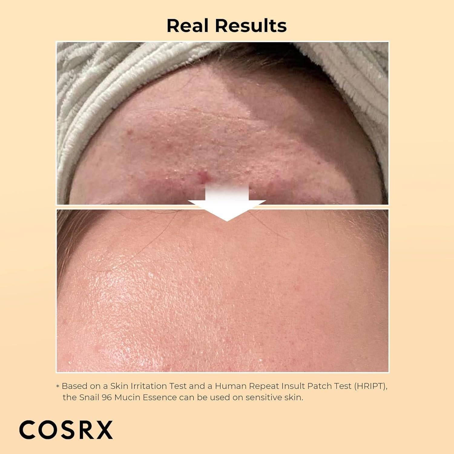 Before and after results using snail mucin power essence showing improved skin texture and appearance