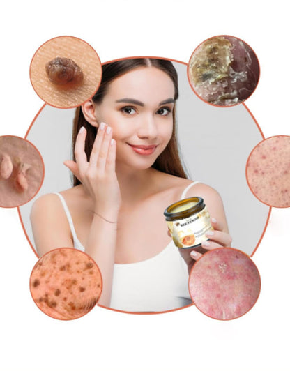 Woman applying bee venom cream for acne scars from The Gir Farmer with close-ups of acne scar treatments