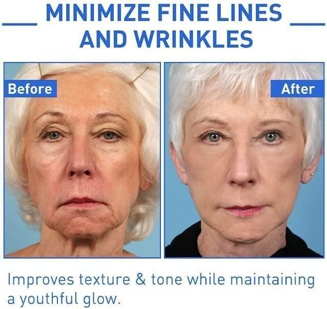 Before and after comparison showing the effectiveness of Botox anti-aging serum for reducing fine lines